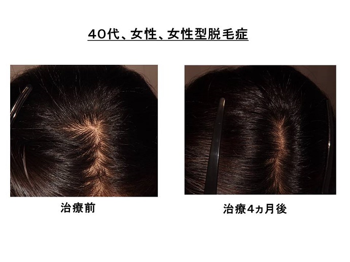 円形脱毛症　病院""